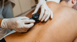 Как лечится рак кожи