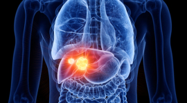 Виявлені основні причини раку печінки