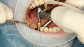 Плюсы установки зубных имплантов