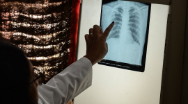 Европа: Число смертей от туберкулеза снова растет, заявляет ВОЗ