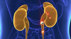 Дослідження доводить: ниркові камені можуть формуватися через бактерії