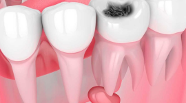 Що таке кіста зуба?