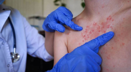 У Бангладеш через спалах кору підтверджено 15 випадків смерті 