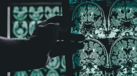 Ранняя диагностика болезни Альцгеймера по одному сканированию мозга