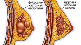 Лечение фиброзно кистозной мастопатии: виды заболевания, причины возникновения 