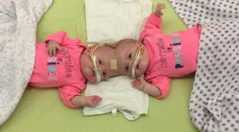 «Одні на 2,5 мільйона» сіамські близнючки, які пережили операцію з розділення, випускаються з дитячого садочка (ФОТО)