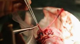 Розслідування: Багатьох людей, яким пересадили органи у Китаї, було інфіковано гепатитом