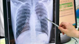 45% населення Китаю заражена туберкульозом