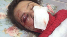 Які травми діагностували в Тетяни Чорновол