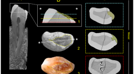 Люди умели пломбировать зубы ещё 6,5 тысяч лет назад