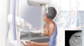 Маммография в Киеве в клинике R+ Medical Network: вопросы и ответы