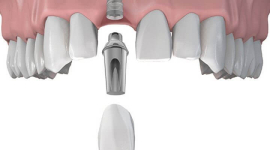 Проведение имплантации зубов в Харькове – современное протезирование вместе с KDS 