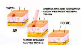 Лазерное удаление родинок, папиллом и бородавок в Харькове