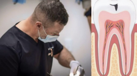 Современное лечение зубов в Бруклине: Пломбирование и удаление в ParkSide Dental