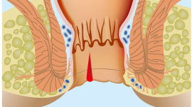 Лечение анальной трещины: действенные методы для быстрого выздоровления