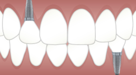 Імплантація зубів та її переваги