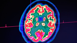 Вчені стверджують, що, можливо, відкрили причину хвороби Альцгеймера