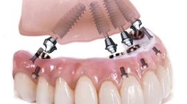 Тотальна реставрація зубів: сучасна методика при адентії