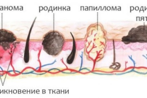 Лазерное удаление папиллом