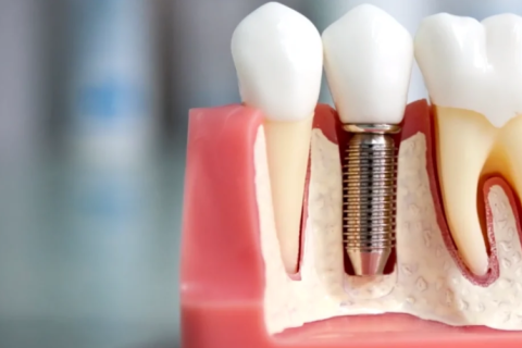 Имплантация: зубной ряд без пробелов