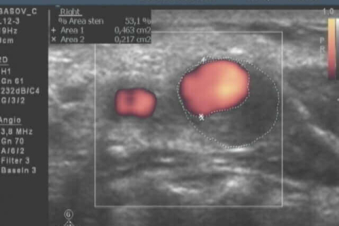 Исследование сосудов в шее и мозге с помощью технологии УЗИ