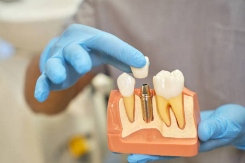 Імплантація після втрати зуба: чому важливо не затягувати з вирішенням проблеми