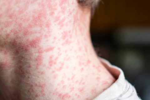 Великобританія та низка інших держав втратили статус країн, що ліквідували кір