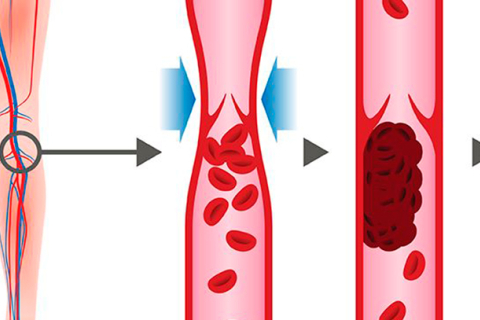 Венозная тромбоэмболия — что это? 