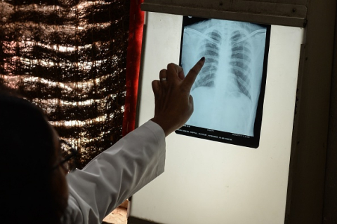 У Європі зростає кількість померлих від туберкульозу (ВІДЕО)