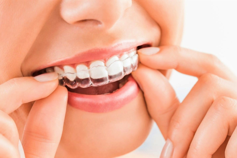 Елайнери «Інвізілайн»: інноваційне рішення для виправлення прикусу та вирівнювання зубів