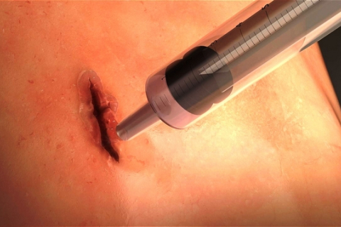 В Австралії створили хірургічний клей MeTro, який «запечатує» рану всього за 60 секунд