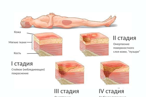 Что такое пролежни и как с ними бороться? 