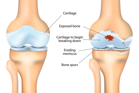 Остеоартроз суставов — что это такое и как лечить? 