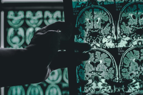 Розроблено спосіб сканування мозку, який швидко діагностує хворобу Альцгеймера