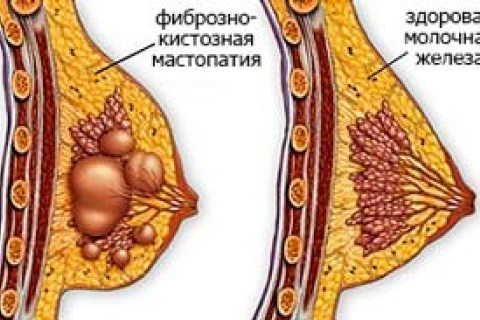 Лечение фиброзно кистозной мастопатии: виды заболевания, причины возникновения 