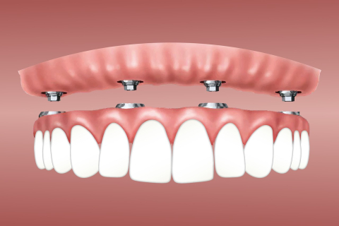О правильном уходе за зубными имплантами