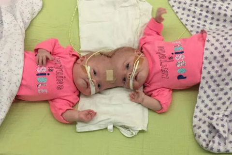 Сиамские близняшки, которые пережили операцию по разделению выпустились из детского сада