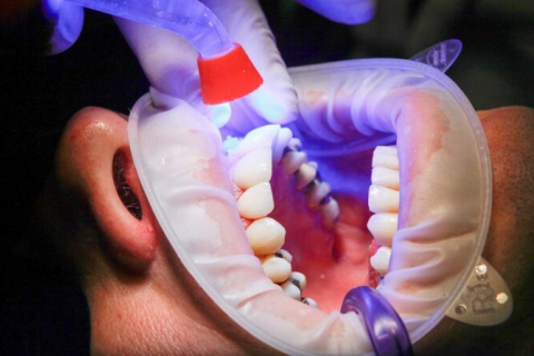 Через відсутність безоплатного доступу до лікування багато британців виривають собі зуби