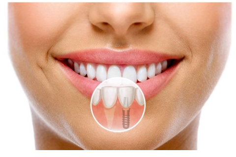 Что нужно знать о зубных имплантах?