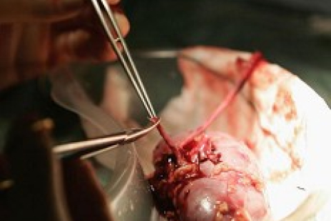 Розслідування: Багатьох людей, яким пересадили органи у Китаї, було інфіковано гепатитом