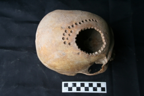 Трепанація черепа у давній Америці: як вона проводилась?