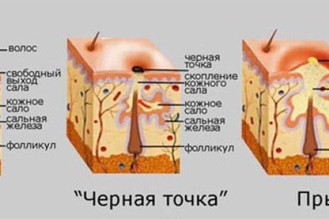 Избавляемся от черных точек: какую чистку лица выбрать?