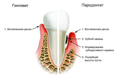 Пародонтит: симптоми і лікування