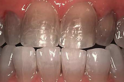 Использование американских виниров для решения проблемы тетрациклиновых зубов