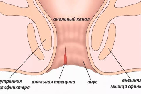 Анальная трещина: причины, симптомы, лечение 