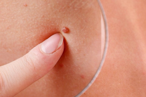Как удалить метки на коже, по мнению дерматологов