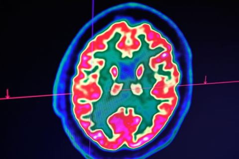 Учёные утверждают, что они, возможно, обнаружили причину болезни Альцгеймера