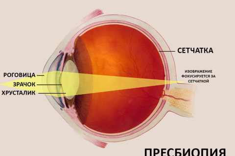 Как справиться с возрастными изменениями зрения?