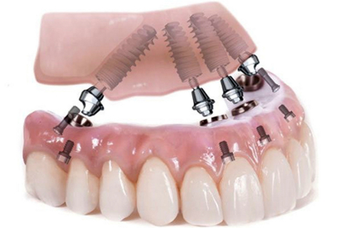 Тотальна реставрація зубів: сучасна методика при адентії